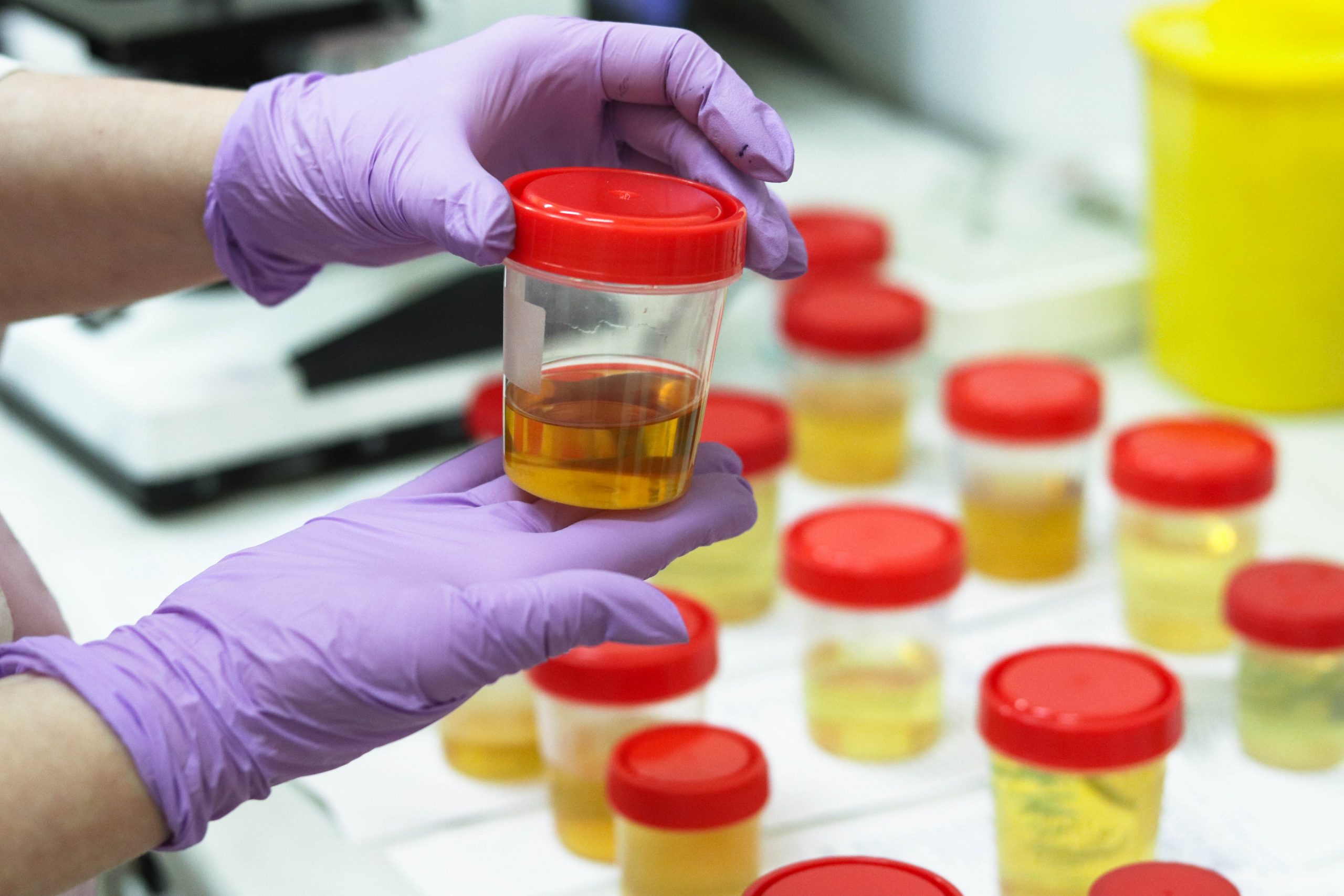 Preparation,Of,Urine,Samples,In,The,Laboratory,In,The,Hospital